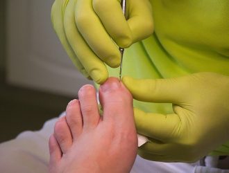 Вросшие ногти — причины и лечение