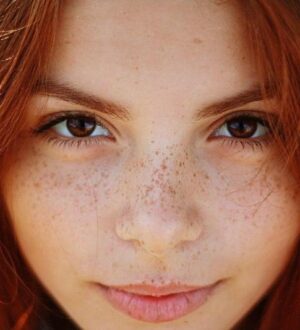 Как избавиться от веснушек и пигментных пятен.